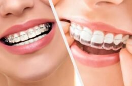 Invisible Aligners vs Traditional Braces: Which One Is Right for Your Smile? – family dental clinic Kayanna